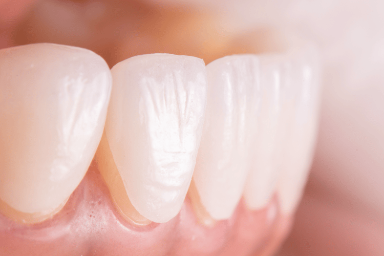 Dental Veneers Fix Chipped, Gapped, or Misshapen Teeth